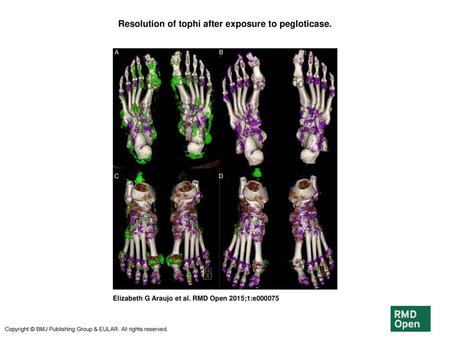 Resolution of tophi after exposure to pegloticase.