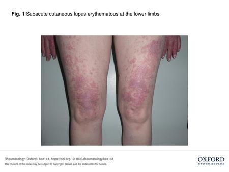 Fig. 1 Subacute cutaneous lupus erythematous at the lower limbs