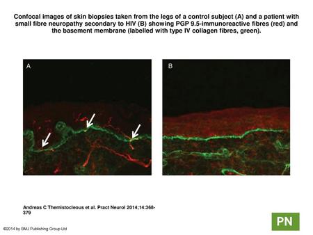 Confocal images of skin biopsies taken from the legs of a control subject (A) and a patient with small fibre neuropathy secondary to HIV (B) showing PGP.