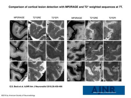 Comparison of cortical lesion detection with MP2RAGE and T2