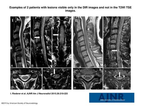 Examples of 2 patients with lesions visible only in the DIR images and not in the T2WI TSE images. Examples of 2 patients with lesions visible only in.