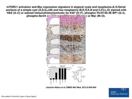 MTORC1 activation and Myc expression signature in atypical cysts and neoplasms.A–O.Serial sections of a simple cyst (A,D,G,J,M) and two neoplasms (B,E,H,K,N.