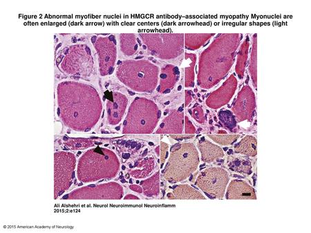 Figure 2 Abnormal myofiber nuclei in HMGCR antibody–associated myopathy Myonuclei are often enlarged (dark arrow) with clear centers (dark arrowhead) or.