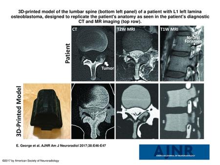 3D-printed model of the lumbar spine (bottom left panel) of a patient with L1 left lamina osteoblastoma, designed to replicate the patient's anatomy as.