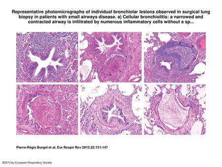 Representative photomicrographs of individual bronchiolar lesions observed in surgical lung biopsy in patients with small airways disease. a) Cellular.