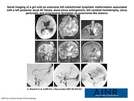 Serial imaging of a girl with an extensive left orbitofrontal lymphatic malformation associated with a left posterior dural AV fistula, dural sinus enlargement,