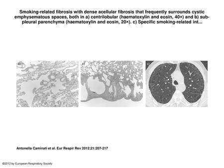 Smoking-related fibrosis with dense acellular fibrosis that frequently surrounds cystic emphysematous spaces, both in a) centrilobular (haematoxylin and.