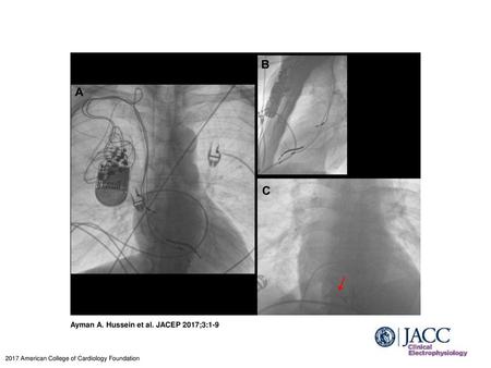 Ayman A. Hussein et al. JACEP 2017;3:1-9