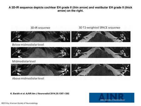 A 3D-IR sequence depicts cochlear EH grade II (thin arrow) and vestibular EH grade II (thick arrow) on the right. A 3D-IR sequence depicts cochlear EH.