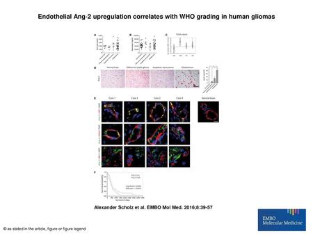 Endothelial Ang‐2 upregulation correlates with WHO grading in human gliomas Endothelial Ang‐2 upregulation correlates with WHO grading in human gliomas.