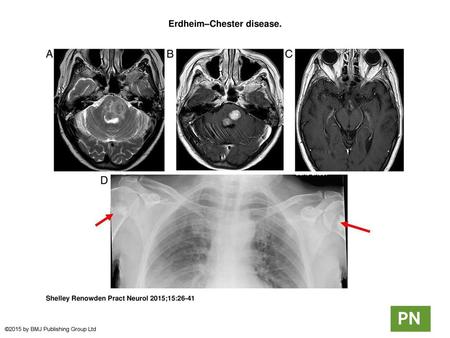 Erdheim–Chester disease.