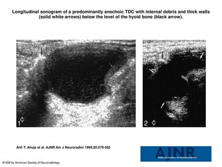 Longitudinal sonogram of a predominantly anechoic TDC with internal debris and thick walls (solid white arrows) below the level of the hyoid bone (black.