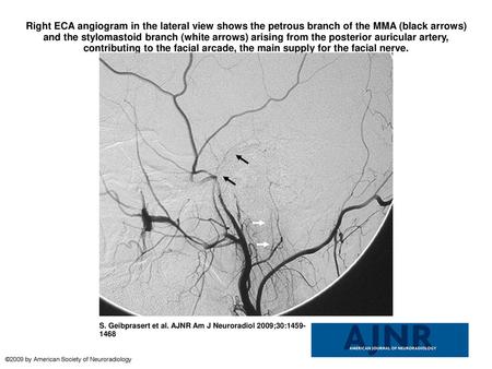 Right ECA angiogram in the lateral view shows the petrous branch of the MMA (black arrows) and the stylomastoid branch (white arrows) arising from the.