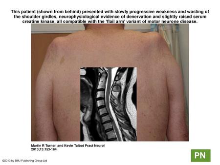 This patient (shown from behind) presented with slowly progressive weakness and wasting of the shoulder girdles, neurophysiological evidence of denervation.