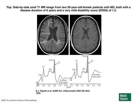 Top: Side-by-side axial T1 MR image from two 29-year-old-female patients with MS, both with a disease duration of 6 years and a very mild disability score.