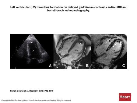 Left ventricular (LV) thrombus formation on delayed gadolinium contrast cardiac MRI and transthoracic echocardiography. Left ventricular (LV) thrombus.