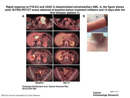 Rapid response to F16-IL2 and LDAC in disseminated extramedullary AML