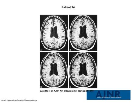 Patient 14. Patient 14. Secondary progressive MS. Axial contrast-enhanced T1-weighted MR image (600/27/1 [TR/TE/excitation]). A, No enhanced lesion can.