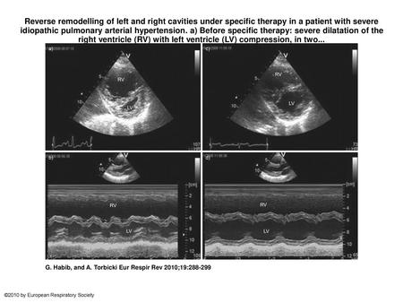 Reverse remodelling of left and right cavities under specific therapy in a patient with severe idiopathic pulmonary arterial hypertension. a) Before specific.