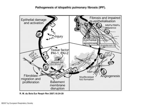 Pathogenesis of idiopathic pulmonary fibrosis (IPF).