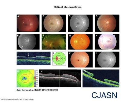 Retinal abnormalities.