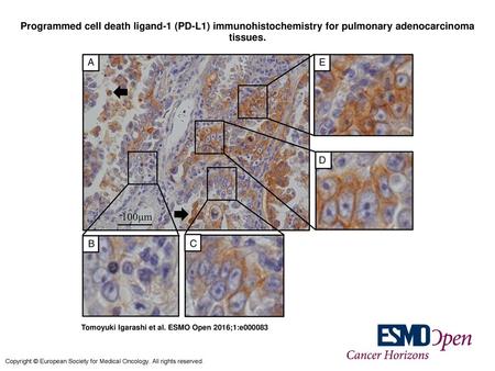 Programmed cell death ligand-1 (PD-L1) immunohistochemistry for pulmonary adenocarcinoma tissues. Programmed cell death ligand-1 (PD-L1) immunohistochemistry.