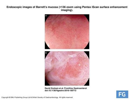 Endoscopic images of Barrett's mucosa (×136 zoom using Pentax iScan surface enhancement imaging). Endoscopic images of Barrett's mucosa (×136 zoom using.