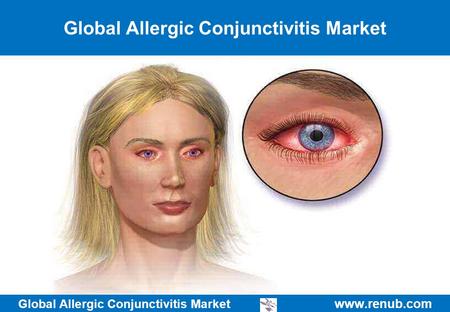 Global Allergic Conjunctivitis Market   Global Allergic Conjunctivitis Market.