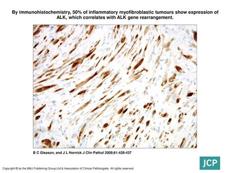 By immunohistochemistry, 50% of inflammatory myofibroblastic tumours show expression of ALK, which correlates with ALK gene rearrangement. By immunohistochemistry,