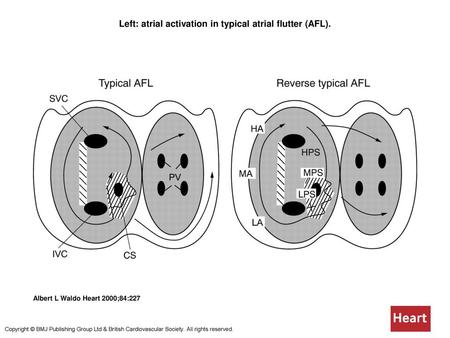 Left: atrial activation in typical atrial flutter (AFL).