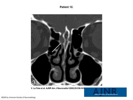 Patient 12. Patient 12. Both readers missed a defect found at endoscopy. Coronal MPR image from 0.625-mm axial dataset missed a subtle defect of the right.