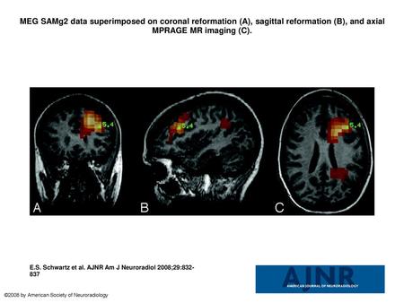 MEG SAMg2 data superimposed on coronal reformation (A), sagittal reformation (B), and axial MPRAGE MR imaging (C). MEG SAMg2 data superimposed on coronal.