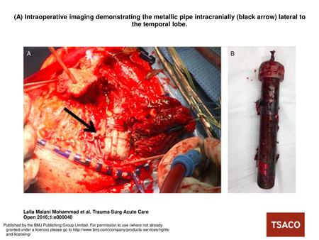 (A) Intraoperative imaging demonstrating the metallic pipe intracranially (black arrow) lateral to the temporal lobe. (A) Intraoperative imaging demonstrating.