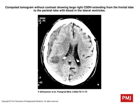 Computed tomogram without contrast showing large right CSDH extending from the frontal lobe to the parietal lobe with blood in the lateral ventricles.