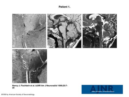 Patient 1. Patient 1. A, Sagittal T1-weighted image (600/8/2) shows a Chiari I malformation, with tonsillar herniation to the mid-C2 level and a pointed.