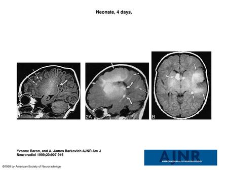 Neonate, 4 days. Neonate, 4 days. Sagittal SE T1-weighted MR image (600/8/2) shows white matter anomalies as punctate hyperintensities (two marked by long.