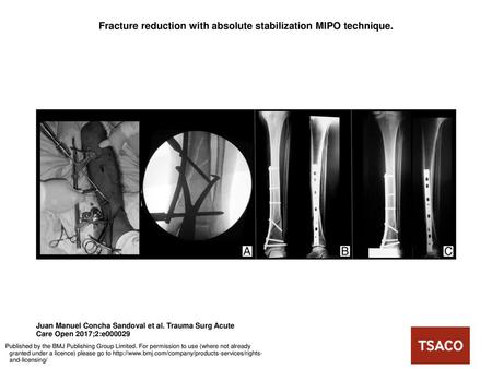 Fracture reduction with absolute stabilization MIPO technique.