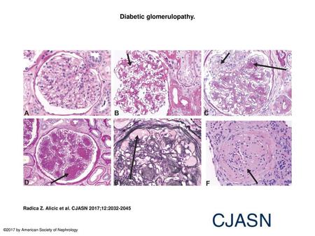 Diabetic glomerulopathy.