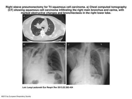 Right sleeve pneumonectomy for T4 squamous cell carcinoma