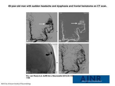 49-year-old man with sudden headache and dysphasia and frontal hematoma on CT scan. 49-year-old man with sudden headache and dysphasia and frontal hematoma.