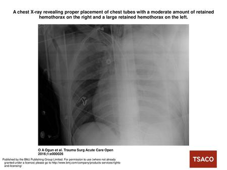 A chest X-ray revealing proper placement of chest tubes with a moderate amount of retained hemothorax on the right and a large retained hemothorax on the.