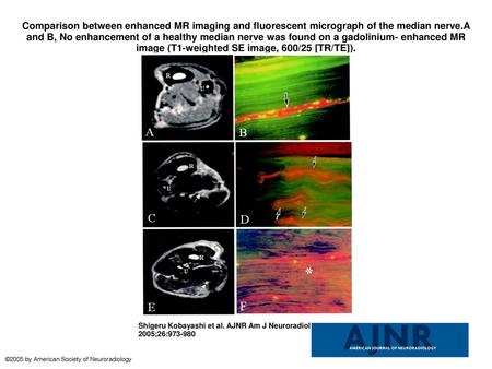 Comparison between enhanced MR imaging and fluorescent micrograph of the median nerve.A and B, No enhancement of a healthy median nerve was found on a.