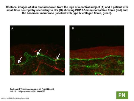 Confocal images of skin biopsies taken from the legs of a control subject (A) and a patient with small fibre neuropathy secondary to HIV (B) showing PGP.