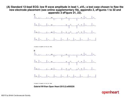 (A) Standard 12-lead ECG: low R wave amplitude in lead 1, aVL; a test case chosen to flaw the new electrode placement (see online supplementary file, appendix.