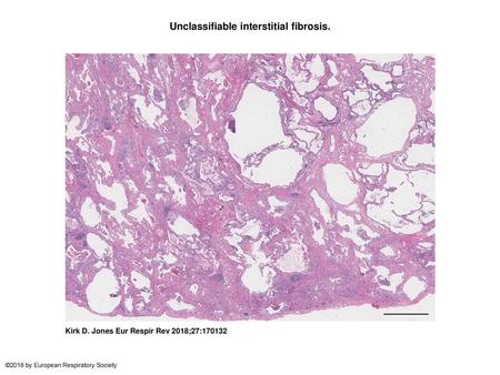 Unclassifiable interstitial fibrosis.