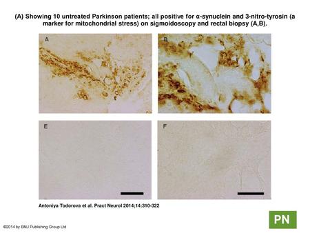 (A) Showing 10 untreated Parkinson patients; all positive for α-synuclein and 3-nitro-tyrosin (a marker for mitochondrial stress) on sigmoidoscopy and.