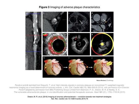 Figure 3 Imaging of adverse plaque characteristics