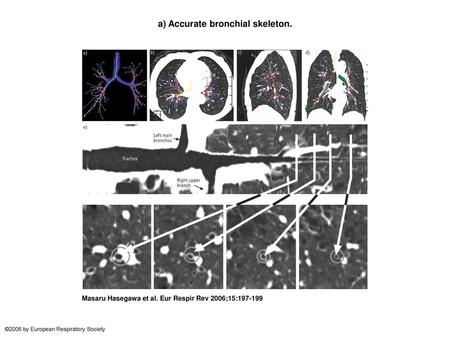 a) Accurate bronchial skeleton.