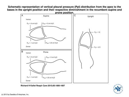 Schematic representation of vertical pleural pressure (Ppl) distribution from the apex to the bases in the upright position and their respective diminishment.