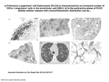 A) Pulmonary Langerhans’ cell histiocytosis (PLCH) is characterised by an increased number of CD1a+ Langerhans’ cells in the bronchiolar wall (200×). b)